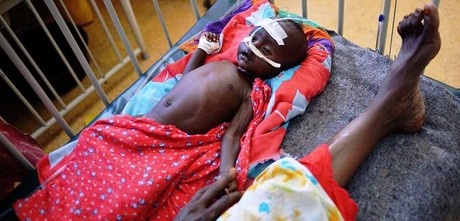 Un niño afectado por la hambruna es atendido en el hospital Banadir de Mogadiscio.