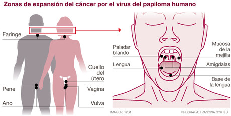 Las zonas de expansión del cáncer por el virus del papiloma humano.